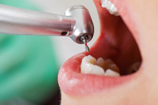 Best Emergency Dental Care for Broken or Chipped Teeth in Providence, UT